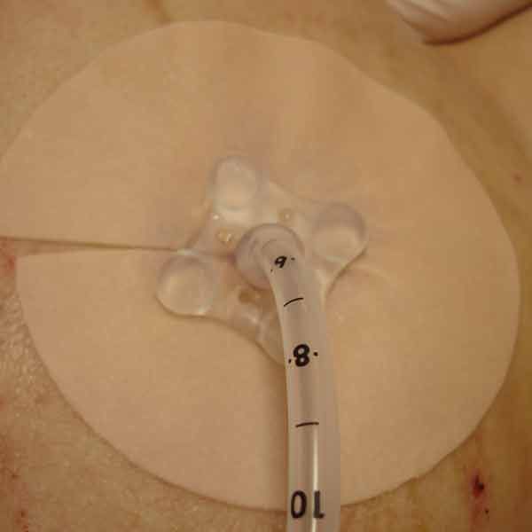 Eakin Surround Large 98mm Skin Protector - Image 2